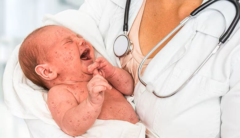 herpes infection infant 01